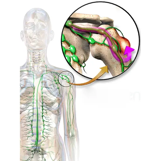 Metastatic Bone Disease: An Overview, Symptoms, Causes & Treatment